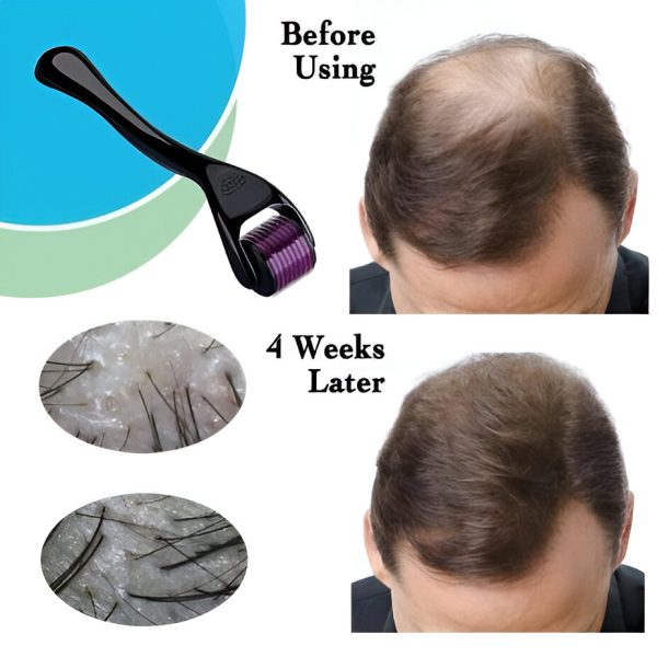 Derma Roller Hair Therapy Micro-needle | Derma Roller For Hair Re-growth & Skin For Male And Female